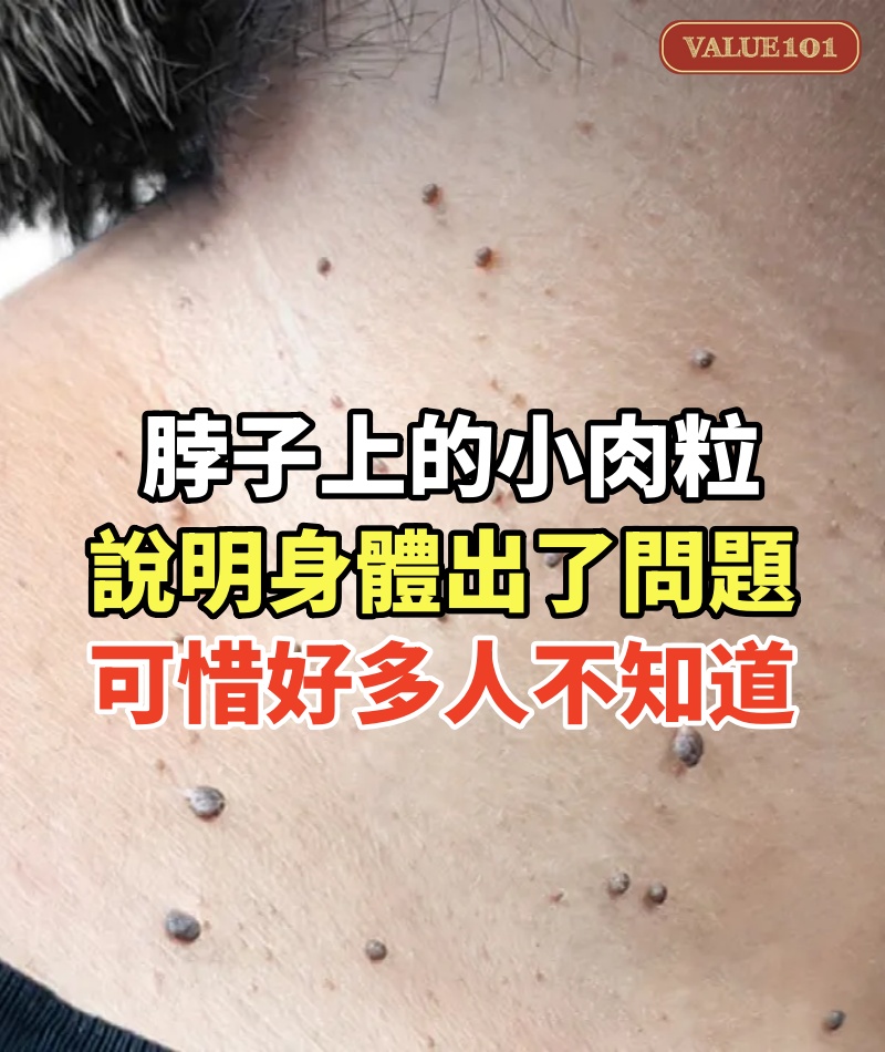 脖子上的小肉粒,說明身體出了問題!可惜好多人不知道