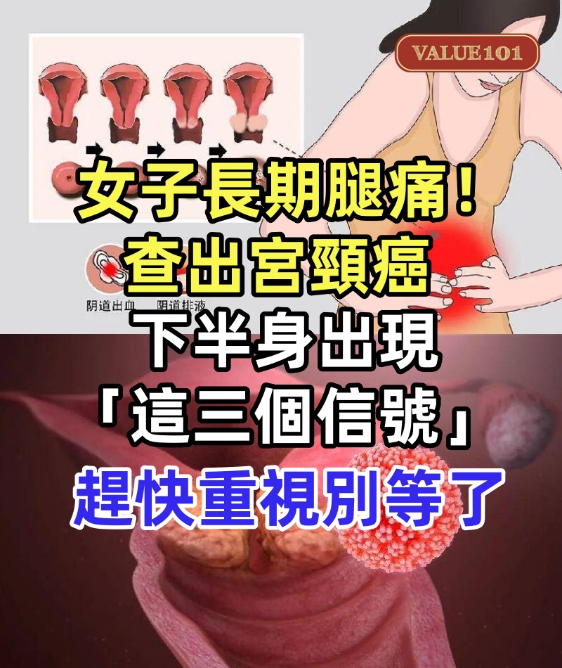 55歲女子長期腿痛!查出宮頸癌 下半身出現「這三個信號」:趕快重視別等了