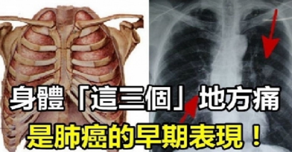 小心！身體「這3個」地方痛，是肺癌的早期表現！趕緊看，別等到肺爛掉再後悔！