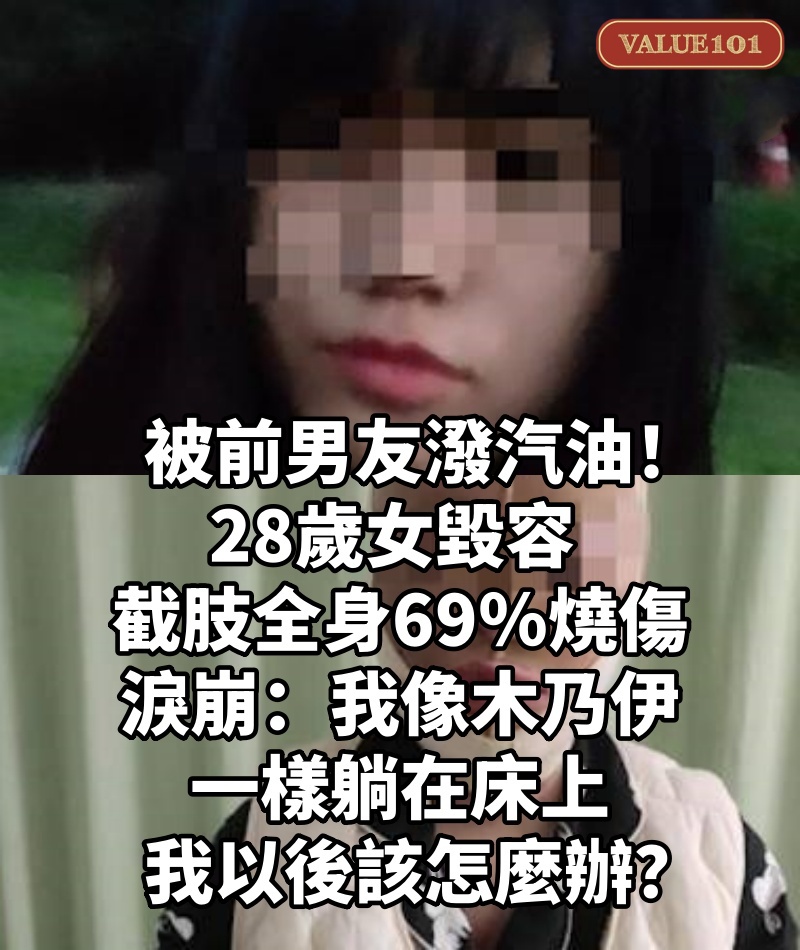 被前男友潑汽油! 28歲女「毀容截肢全身69%燒傷」淚崩「我像木乃伊一樣躺在床上」:我以後該怎麼辦