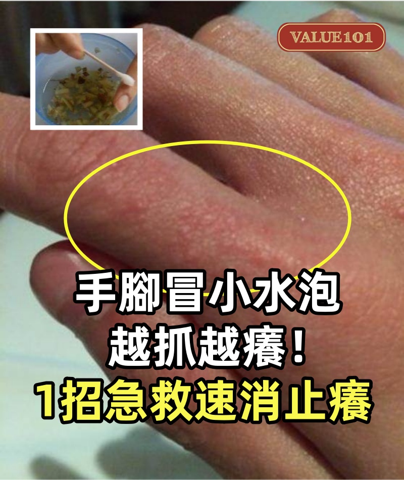 手腳狂冒「小水泡」越抓越癢!醫師警告:千萬別抓「1招急救」不花半毛錢速消止癢