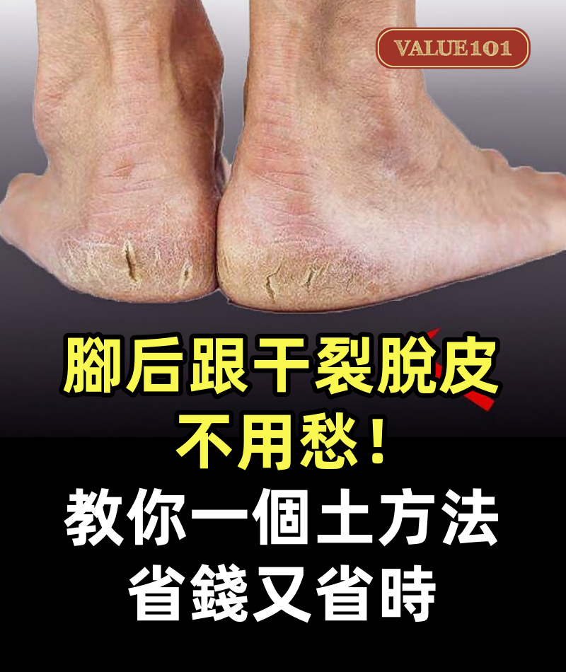 腳后跟干裂脫皮不用愁!教你一個「土方法」,省錢又省時